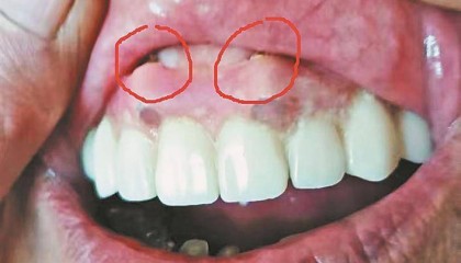 绥化刘先生反映其母亲种牙后，牙龈鼓俩大包，顶嘴唇！哈尔滨市优诺口腔回应